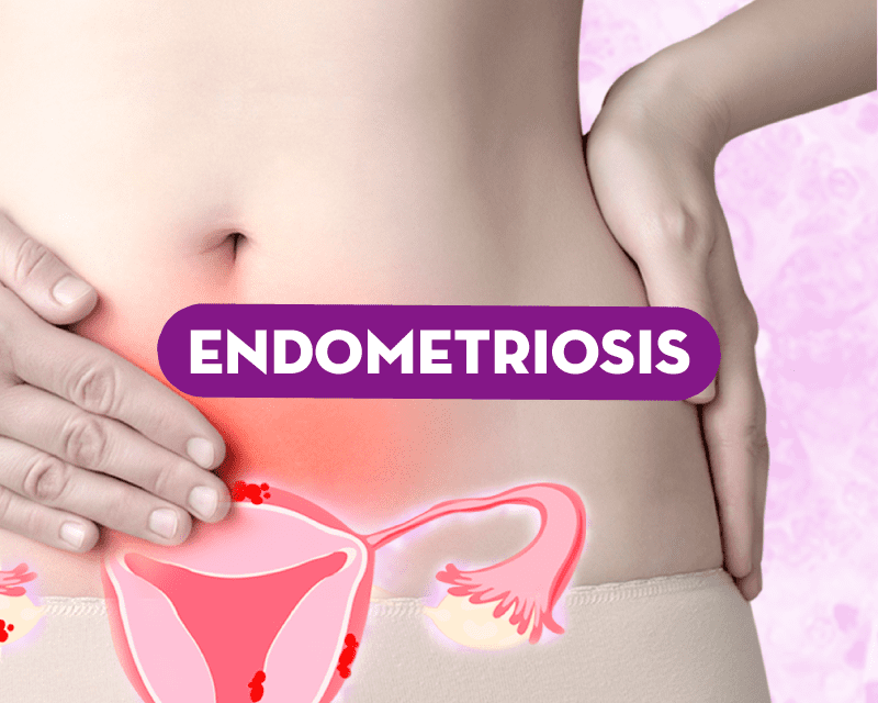 ¿Qué es endometriosis?