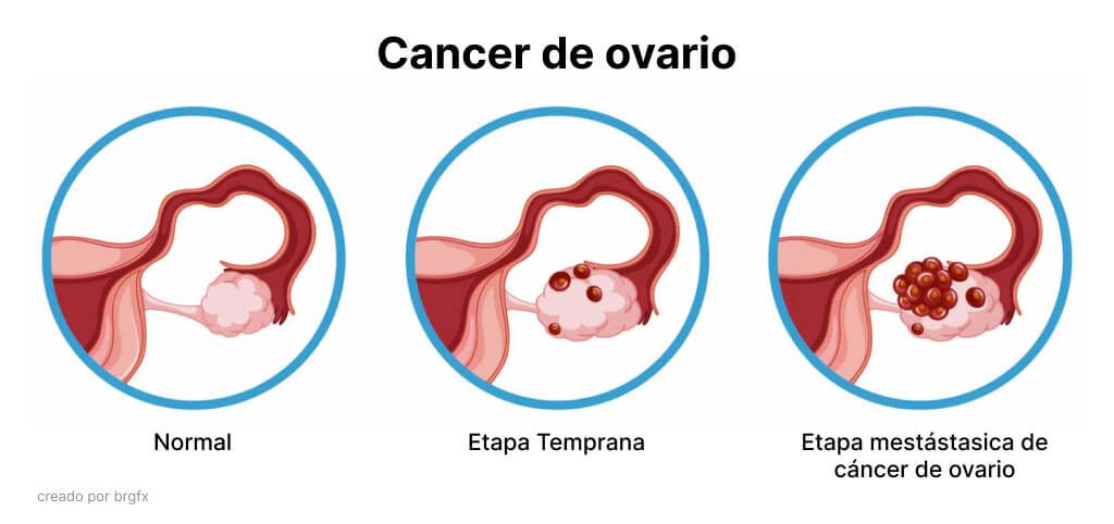 Cáncer De Ovario Fundación Valle Del Lili 1387